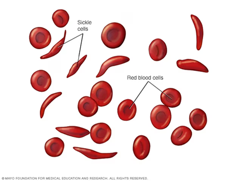 Sickle and Red Blood Cells